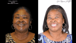 Woman before and after Full Mouth Smile Rehabilitation