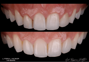 Lateral Incisor Veneers
