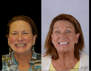 Woman with Full Mouth Smile Rehabilitation
