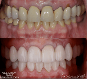 Before & After - Full Mouth Smile Rehabilitation