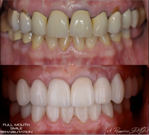 Before & After - Full Mouth Smile Rehabilitation