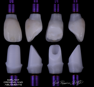 Implant, Crowns, and Abutments