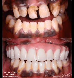 Maxillary Hybrid Prosthesis - Before and After Photos