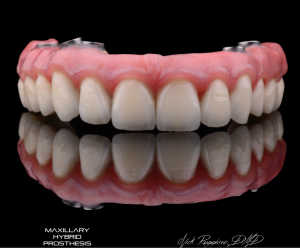 Maxillary Hybrid Prosthesis - top teeth