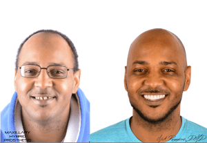 Maxillary Hybrid Prosthesis Before & After Photos