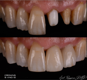 Crowns 9 & 10 Before and After
