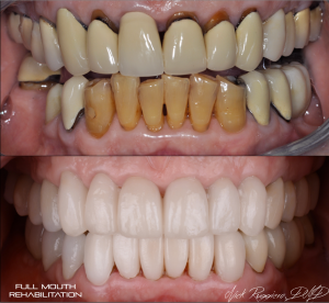 Full Mouth Rehabilitation - Before and After