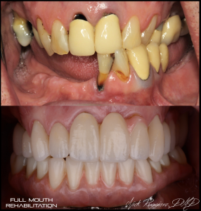 Full Mouth Rehabilitation - Missing Teeth in Before Photo