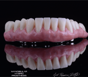Mandibular Hybrid Prosthesis