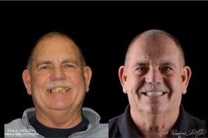 Man with Full Mouth Smile Rehabilitation