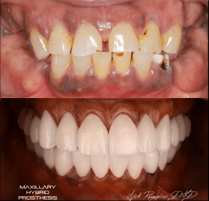 Maxillary Hybrid Prosthesis