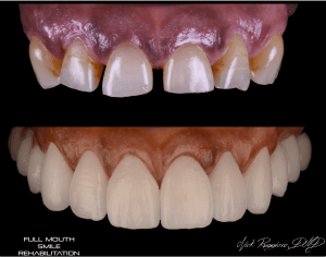 Full Mouth Smile Rehabilitation - Top Teeth