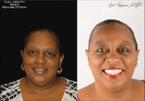 Full Mouth Smile Rehabilitation Before & After Photos with new bright, white teeth.