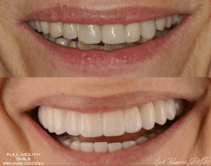 Full Mouth Smile Rehabilitation