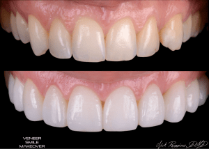 Veneer Smile Makeover