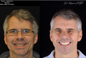 Full Mouth Rehabilitation Before & After Photos