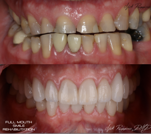 Full Mouth Smile Rehabilitation Before & After Photos