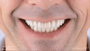 After photo of nice new smile