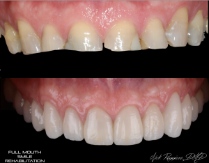 Full Mouth Smile Rehabilitation - Teeth before were small and broken
