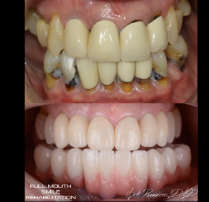 Full Mouth Smile Rehabilitation - Before Teeth were rotting out
