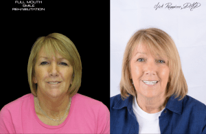 Woman with Full Mouth Smile Rehabilitation