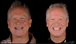 Man with Full Mouth Smile Rehabilitation