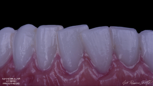 Mandibular Hybrid Prosthesis. Close up of teeth.