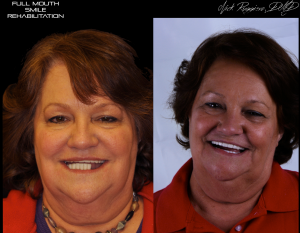 Woman before and after Full Mouth Smile Rehabilitation, was missing bottom teeth before