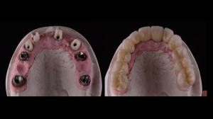 Mold of before and after teeth