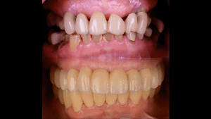 Before and After photo of teeth