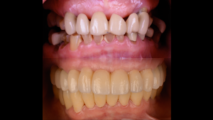 Before and After photo of teeth