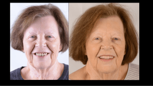 Older woman with new teeth.