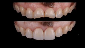 Before and after photos of Full Mouth Smile Rehabilitation