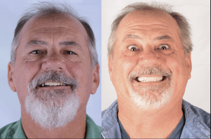 Older man, very happy with new teeth.