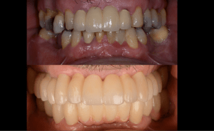 Before and after with new white teeth