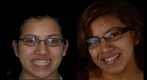 Before and after fixed teeth, was missing a tooth.