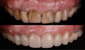 Before and after photos with previous cracked teeth