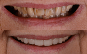 Before and after photos of new teeth and previous cracked teeth