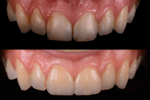 Before and after fixed teeth