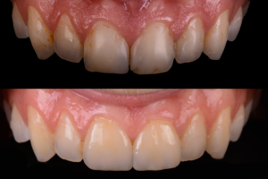 Before and after fixed teeth