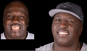 Missing tooth before & after image