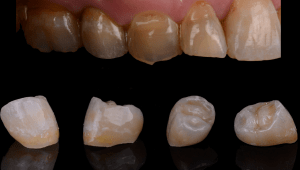 Individual teeth