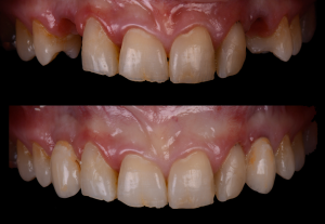 Missing two top teeth before and after photos