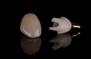 dental crown