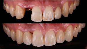 Missing top tooth before and after photos