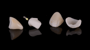 dental implant