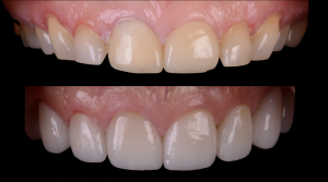 before and after images of teeth