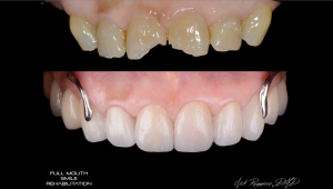  Full Mouth Smile Rehabilitation - Front teeth broken in before image